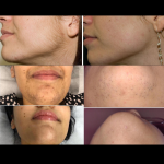 Topical Eflornithine Facial Hair Inhibitor Cream 15G - Image 2